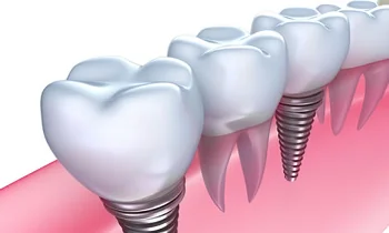 Dental implants